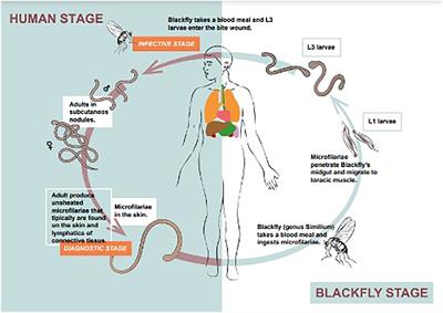 Onchocerciasis: Current knowledge and future goals
